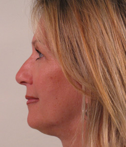 Click to View Nose Surgery Gallery