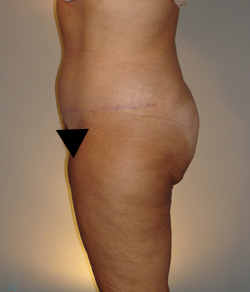 Tummy Tuck After - Ft. Myers FL