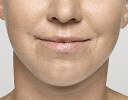 Restylane® Silk After - Ft. Myers FL