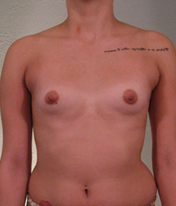 Breast Augmentation Before - Ft. Myers FL