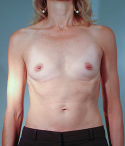 Breast Augmentation Before - Ft. Myers FL