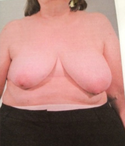 Breast Reconstruction Before - Ft. Myers FL