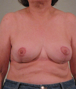 Breast Reconstruction After - Ft. Myers FL