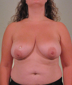 Breast Reconstruction Before - Ft. Myers FL