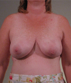 Breast Reconstruction After - Ft. Myers FL