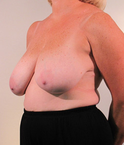 Breast Reduction Before - Ft. Myers FL
