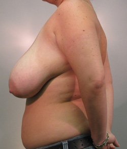 Breast Reduction Before - Ft. Myers FL