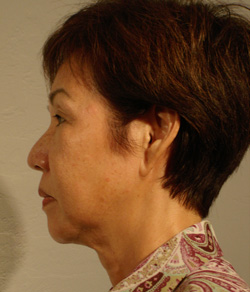 Facelift Before - Ft. Myers FL