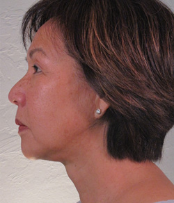 Facelift After - Ft. Myers FL