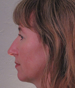 Nose Surgery (Rhinoplasty) Before - Ft. Myers FL