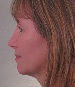 Nose Surgery (Rhinoplasty) After - Ft. Myers FL