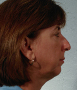 Nose Surgery (Rhinoplasty) Before - Ft. Myers FL