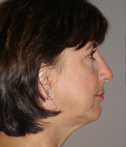 Nose Surgery (Rhinoplasty) After - Ft. Myers FL