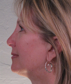 Nose Surgery (Rhinoplasty) After - Ft. Myers FL