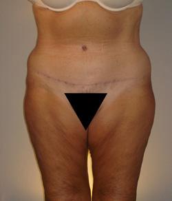 Tummy Tuck After - Ft. Myers FL