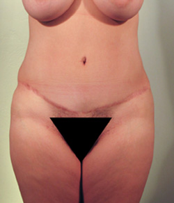 Tummy Tuck After - Ft. Myers FL