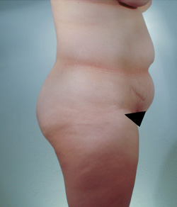 Tummy Tuck Before - Ft. Myers FL