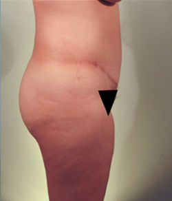 Tummy Tuck After - Ft. Myers FL