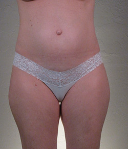 Tummy Tuck Before - Ft. Myers FL