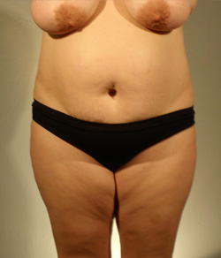 Tummy Tuck Before - Ft. Myers FL