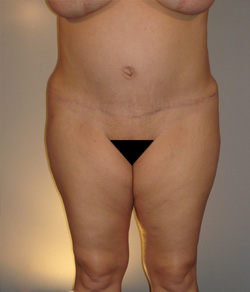 Tummy Tuck After - Ft. Myers FL