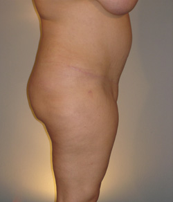 Tummy Tuck After - Ft. Myers FL