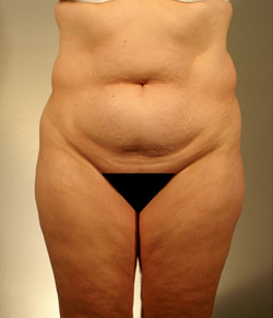 Tummy Tuck Before - Ft. Myers FL