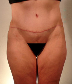 Tummy Tuck After - Ft. Myers FL