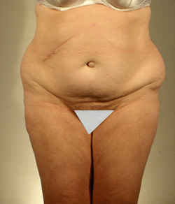 Tummy Tuck Before - Ft. Myers FL