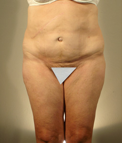Tummy Tuck After - Ft. Myers FL