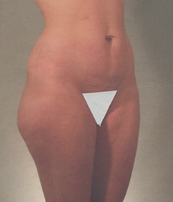 Tummy Tuck Before - Ft. Myers FL