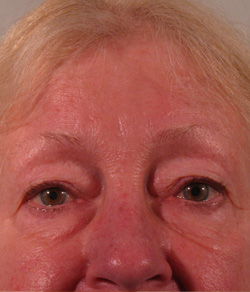 Eyelid Lift Before - Ft. Myers FL