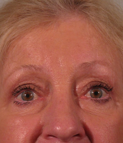 Eyelid Lift After - Ft. Myers FL
