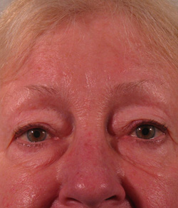 Eyelid Lift Before - Ft. Myers FL