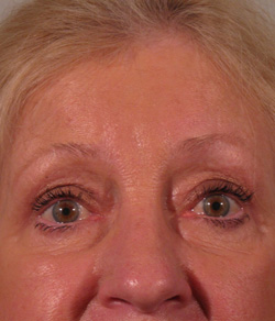 Eyelid Lift After - Ft. Myers FL