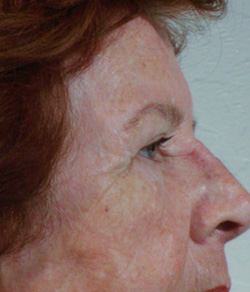 Eyelid Lift Before - Ft. Myers FL