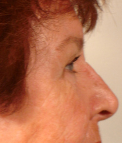 Eyelid Lift After - Ft. Myers FL 