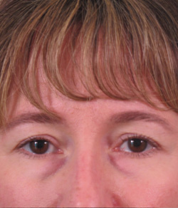 Eyelid Lift Before - Ft. Myers FL