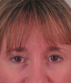 Eyelid Lift After - Ft. Myers FL