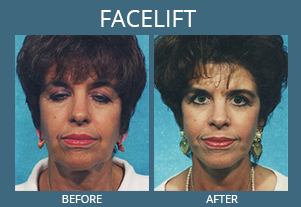 Botox Fort Myers, FL - Cape Coral, FL Medical Spa