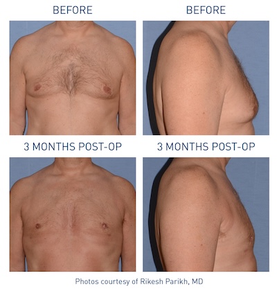 Before and after Renuvion® skin tightening