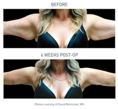 Before and after Renuvion® skin tightening