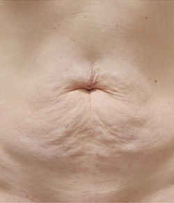 Click to View Renuvion® Gallery