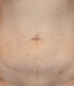 Click to View Renuvion® Gallery