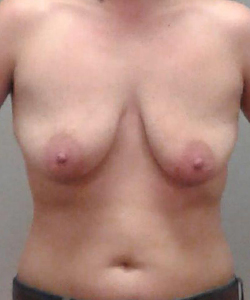 Breast Lift Before - Ft. Myers FL