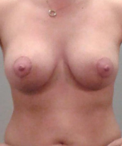 Breast Lift After - Ft. Myers FL