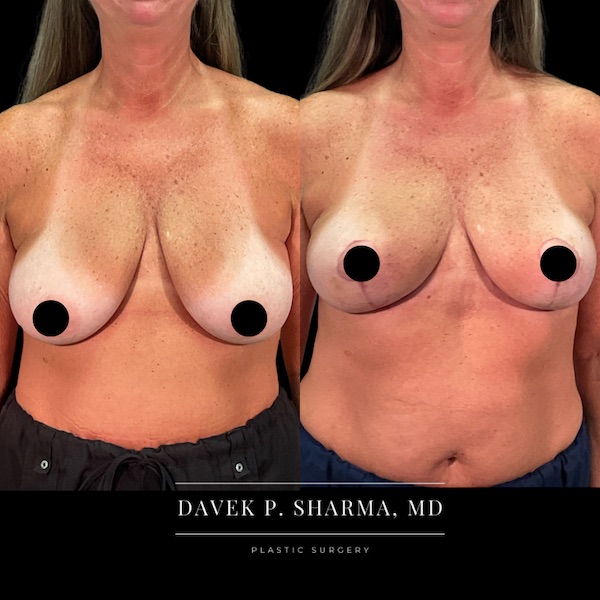 Breast Lift Before and After - Ft. Myers FL