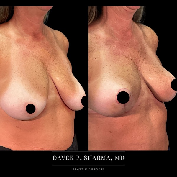 Breast Lift Before and After - Ft. Myers FL