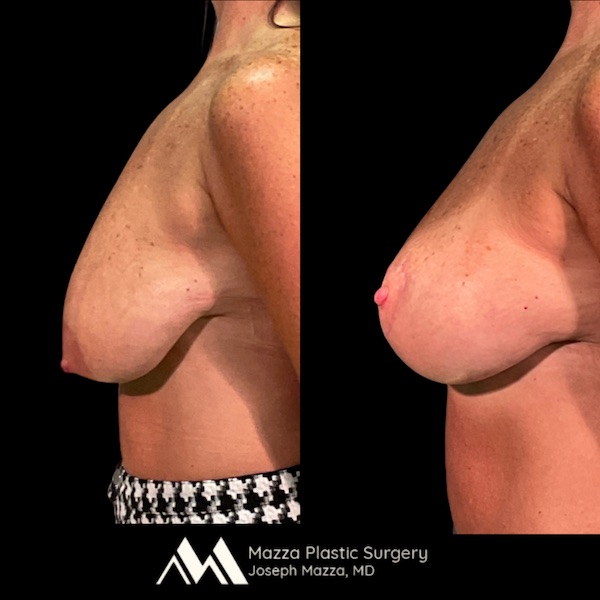 Breast Lift Before and After - Ft. Myers FL