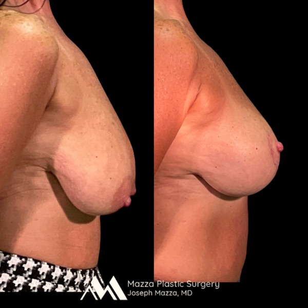 Breast Lift Before and After - Ft. Myers FL